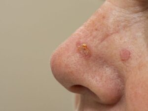 Basal Cell Carcinoma