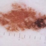 Melanoma-1201890235-scaled-664x442x38x0x590x442x1660121180