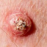 keratoacanthoma-scaled-610x442x10x0x590x442x1660215415