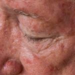 solar-keratosis-scaled-664x442x36x0x590x442x1660122178